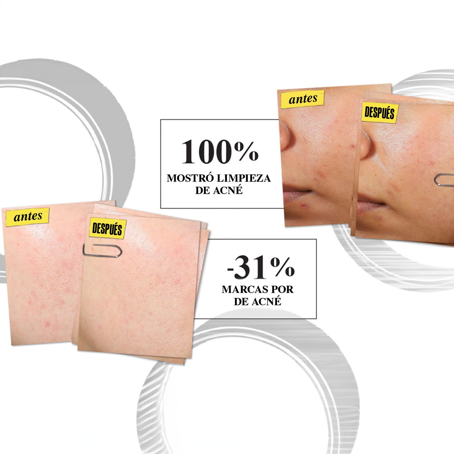Expertly Clear Moisturizer for Acne Prone Skin with Salicylic Acid
