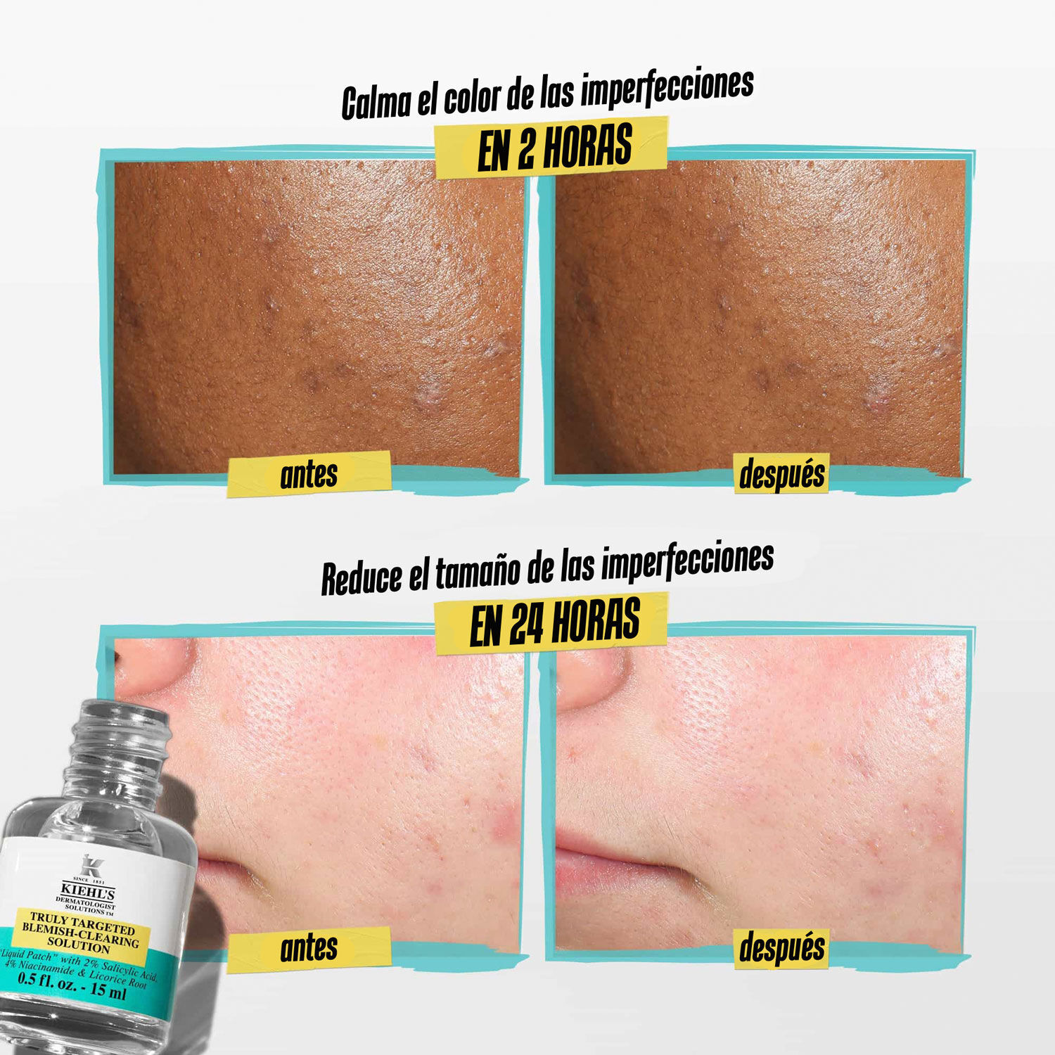 Truly Targeted Acne-Clearing Pimple Patch with Salicylic Acid