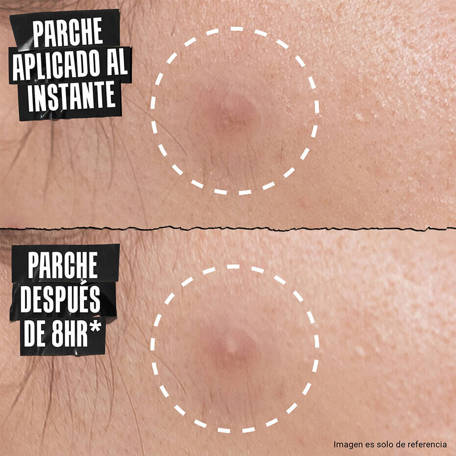 Truly Targeted Overnight Blemish Patch